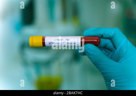 Hand in blauem Handschuh mit Testflasche mit Blutprobe von Coronavirus (Covid-19), Coronavirus Covid 19 infizierter Blutprobe. Positives Ergebnis Stockfoto