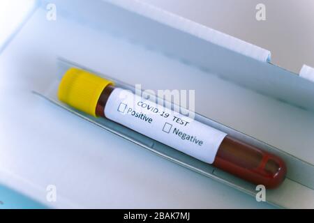 Hand in blauem Handschuh mit Prüfflasche mit Blutprobe von Coronavirus (Covid-19), Blutprobe Coronavirus Covid 19 Stockfoto