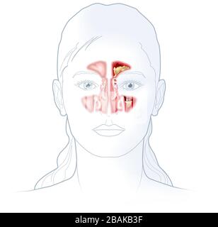 Abbildung: Gesunde Sinus- und Sinusitis mit entzündetem Futter, verstopften Nasennebenöffnungen, Adenoid und überschüssigem Schleim Stockfoto