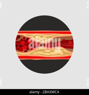 Arterie mit Blutzellen entbehagen Stock Vektor