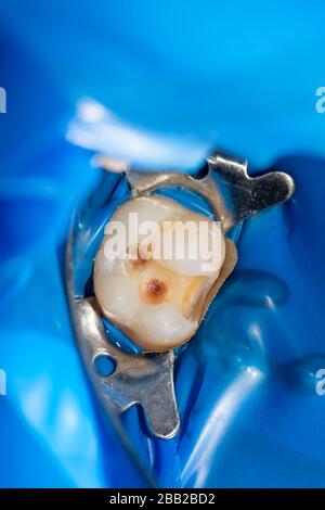 Zahnkaries. Befüllung mit Dentalkomposit-Photopolymer-Material mit Tollern. Das Konzept der Zahnbehandlung in der Zahnklinik Stockfoto