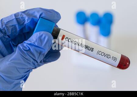 Blutprobe Coronavirus Covid 19, Virus-Bluttest SARS COV 2 Stockfoto