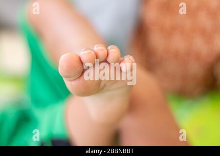 Babyfüße und Zehen haben Narben an den Zehen Stockfoto