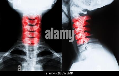 Röntgenbild der Halswirbelsäule isoliert auf schwarzem Hintergrund Stockfoto