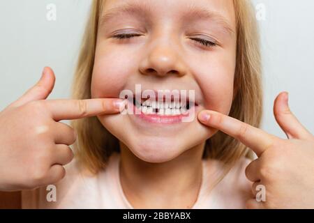 Kind zeigt den ersten Milchzahn. Zahnwechselkonzept. Süßes kleines Mädchen mit blondem Haar auf grauem Hintergrund Stockfoto