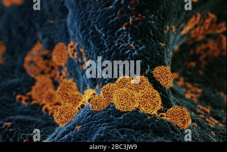Elektronische Mikroskopie von Coronavirus SARS COVID-19, die menschliche Zellen infiziert, 3D-Illusion auf der Grundlage elektronischer mikroskopischer Fotos Stockfoto