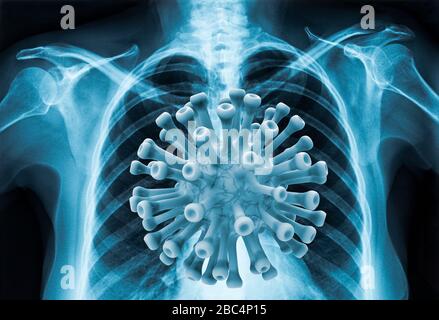 Coronavirus-Krankheit COVID-19 Virusinfektion in der menschlichen Lunge, neue Corona-Virusinfektion oder COVID (Novel Coronavirus 2019 disease,COVID-19,nCoV,SARS-Co Stockfoto
