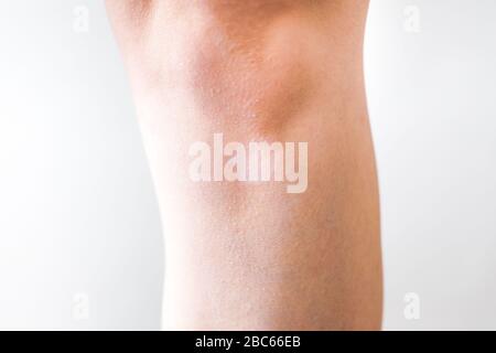 Weißer Vitiligo auf der Haut, Mangel an Melanin Stockfoto