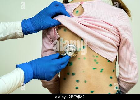 Arzt, der ein Kind mit Stethoskop untersucht, das mit grünen Ausschlägen auf dem Rücken bedeckt ist, der an Windpocken, Masern oder Röteln erkrankt ist. Stockfoto