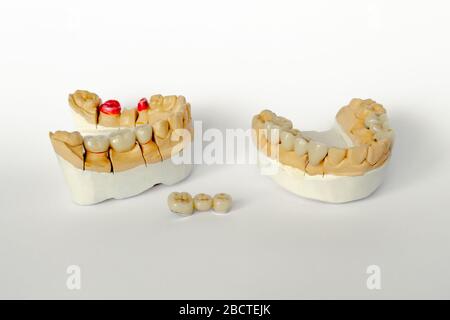 Orthopädische Zahnheilkunde. Zahnersatz Konzept. Zahnprothetik. Cermet Zähne. Keramik Brücken. Gips Modell des Kiefers und Zähne. Weißer Hintergrund Stockfoto