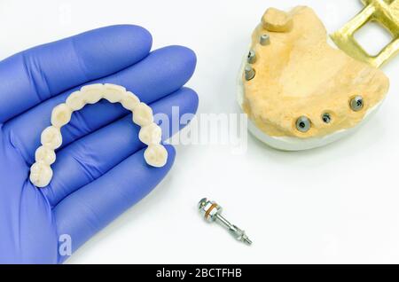 Künstliche Zähne in der Hand des Zahnarztes. Keramik Zahnbrücke für Prothetik auf Zahnimplantaten. Abverschraubte Zahnabutment und Modell mit Zahnimpl Stockfoto