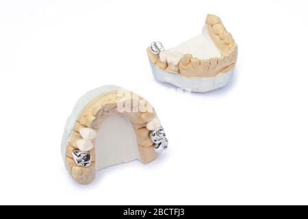 Keramik-Metall-Brücken auf den Modellen der oberen und unteren Kiefer. prothetik von beschädigten und fehlenden Zähnen. Isoliert Stockfoto