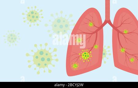 Viruszellen in der Lunge. Infizierte Lunge. Coronavirus, COVID-19. 2019-nCoV. Lungenkrankheit, Pneumonie, Asthma, Krebs, Tuberkulose. Stock Vektor