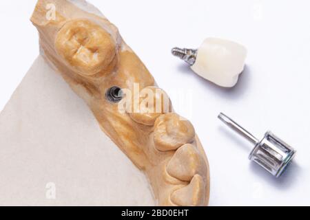 Zahnimplantat im Unterkiefer Nahaufnahme. Gipsmodell des Unterkiefers mit einer Krone auf dem Implantat und einem Schraubendreher sind auf einem weißen Backgrou isoliert Stockfoto