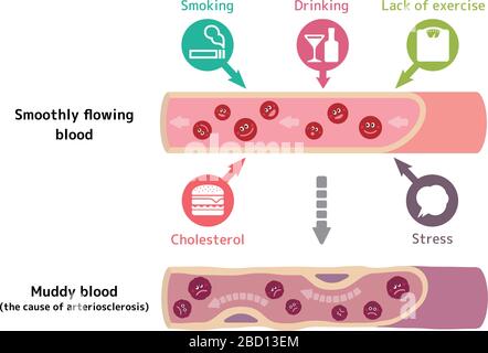 Illustration, dass gesundes Blut schlammiges Blut aufgrund verschiedener ungesunder Faktoren, die Arteriosklerose Stock Vektor