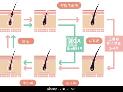 Vergleichende Darstellung des normalen Haarzyklus und der AGA (androgenetische Alopezie) Stock Vektor