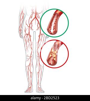 Abbildung: Gesunde Arterie und Arteria arterioslerotisch, periphere Arteria okklusiv. Stockfoto