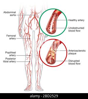 Abbildung: Gesunde Arterie und Arteria arterioslerotisch, periphere Arteria okklusiv. Stockfoto