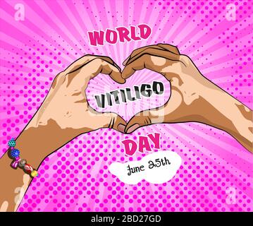 Welt-Vitiligo-Tag 25. Juni. Unisex oder Womane Hände in Herzform auf strahlend rosafarbenem Hintergrund als Pop-Art-Stil. Stock Vektor