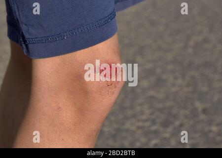 Wunde am Knie gequetscht Wunde am Knie, der Junge fiel und kratzte sein Knie Stockfoto