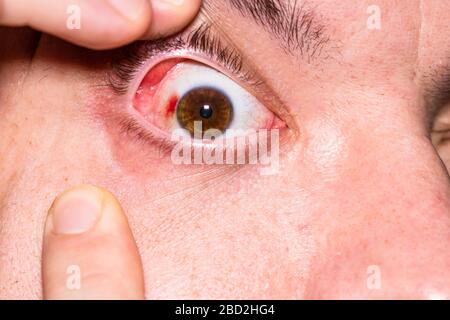 Augenverletzungen, junger Mann mit Platzen von Blutgefäßen im Auge, Ermüdung, Probleme mit den Blutgefäßen Stockfoto