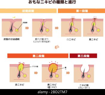Aknearten und Progressionsdarstellung Stock Vektor