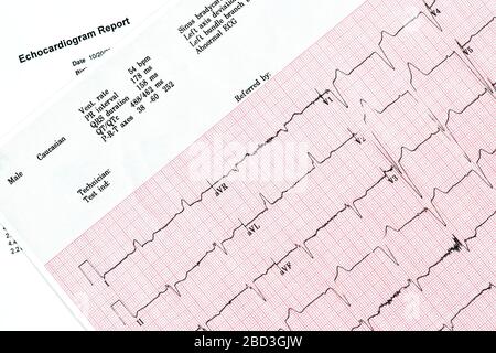 Nahaufnahme des EKG-Berichts (Ecocardiography Report) mit unregelmäßigem Herzschlag Stockfoto