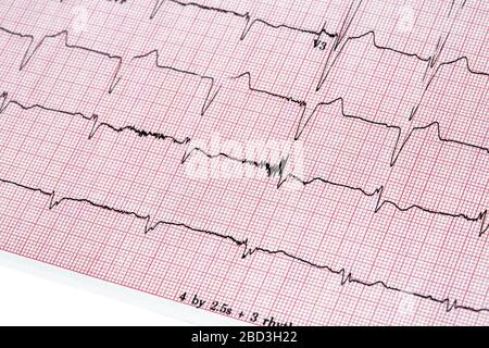 Nahaufnahme des EKG-Berichts (Ecocardiography Report) mit unregelmäßigem Herzschlag Stockfoto