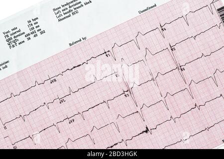 Nahaufnahme des EKG-Berichts (Ecocardiography Report) mit unregelmäßigem Herzschlag Stockfoto