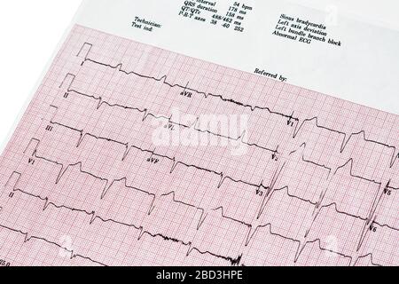 Nahaufnahme des EKG-Berichts (Ecocardiography Report) mit unregelmäßigem Herzschlag Stockfoto