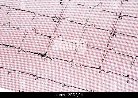 Nahaufnahme des EKG-Berichts (Ecocardiography Report) mit unregelmäßigem Herzschlag Stockfoto