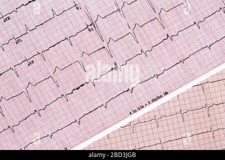 Nahaufnahme von zwei verschiedenen EKG-Testberichten (Ecocardiography Test Reports), die einen abnormalen Herzrhythmus zeigen Stockfoto