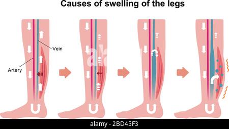 Ursache für Schwellungen (Ödem) der Beine. Flache Abbildung Stock Vektor