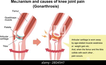 Mechanismus und Ursachen von Kniegelenkschmerzen (Gonarthrose / Arthrose / Arthrose des Knies). Flache Abbildung. Stock Vektor