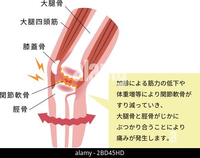 Mechanismus und Ursachen von Kniegelenkschmerzen (Gonarthrose / Arthrose / Arthrose des Knies). Flache Abbildung. Stock Vektor