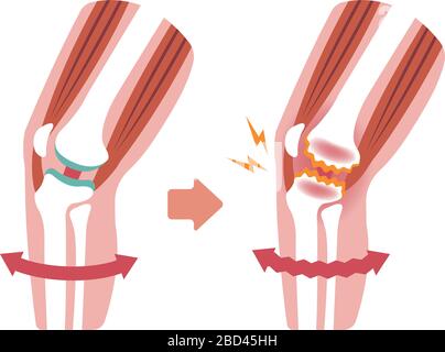 Mechanismus und Ursachen von Kniegelenkschmerzen (Gonarthrose / Arthrose / Arthrose des Knies). Flache Abbildung. Stock Vektor