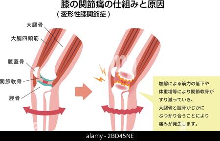 Mechanismus und Ursachen von Kniegelenkschmerzen (Gonarthrose / Arthrose / Arthrose des Knies). Flache Abbildung. Stock Vektor