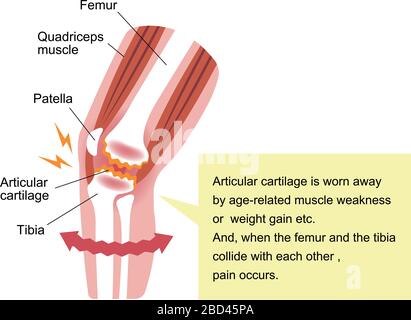 Mechanismus und Ursachen von Kniegelenkschmerzen (Gonarthrose / Arthrose / Arthrose des Knies). Flache Abbildung. Stock Vektor