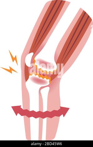 Mechanismus und Ursachen von Kniegelenkschmerzen (Gonarthrose / Arthrose / Arthrose des Knies). Flache Abbildung. Stock Vektor