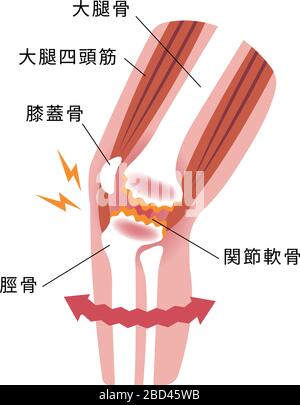 Mechanismus und Ursachen von Kniegelenkschmerzen (Gonarthrose / Arthrose / Arthrose des Knies). Flache Abbildung. Stock Vektor