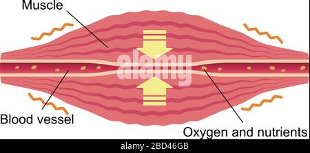 Blutgefäß komprimiert. Flache Darstellung von Muskel und Gefäß. Stock Vektor