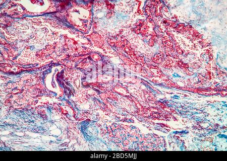 Fibroepithel erkranktes Gewebe 100x Stockfoto