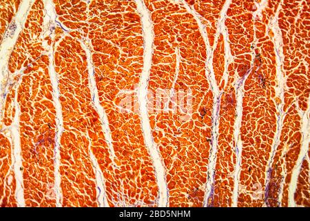 Herzmuskelentzündung erkranktes Gewebe 100x Stockfoto