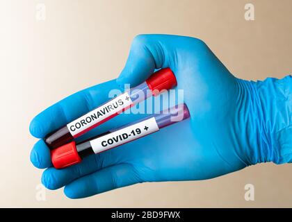 Hand in Handschuh hält Röhrchen mit positiver Blutprobe für die Coronavirus COVID-19-Disiase, Stockfoto