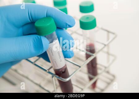 Nahaufnahme der Hand in einem chirurgischen Handschuh, der die Blutprobe hält Stockfoto