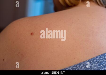 Frau mit Geburtsspuren auf der Haut, Entfernung von Hautfahnen. Stockfoto