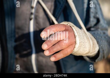 Geschwollene gebrochene Hand des alten Mannes in schmutzigen weißen Verband Stockfoto