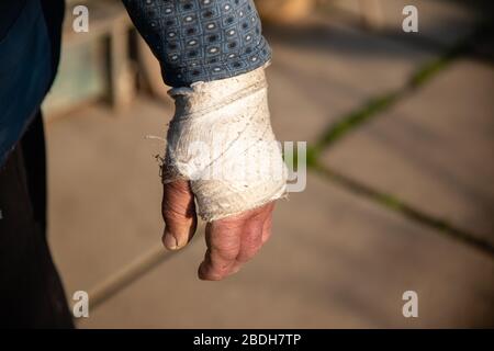 Geschwollene gebrochene Hand des alten Mannes in schmutzigen weißen Verband Stockfoto