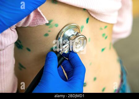 Arzt, der ein Kind mit Stethoskop untersucht, das mit grünen Ausschlägen auf dem Rücken bedeckt ist, der an Windpocken, Masern oder Röteln erkrankt ist. Stockfoto