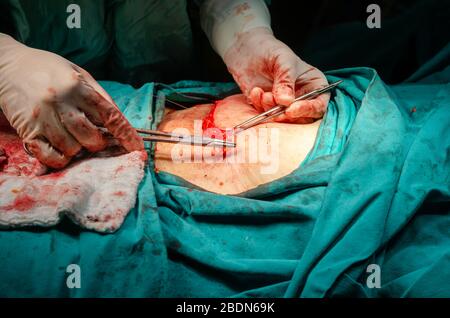 Ein Chirurg näht eine Wunde nach einer Operation in einem Krankenhaus Stockfoto